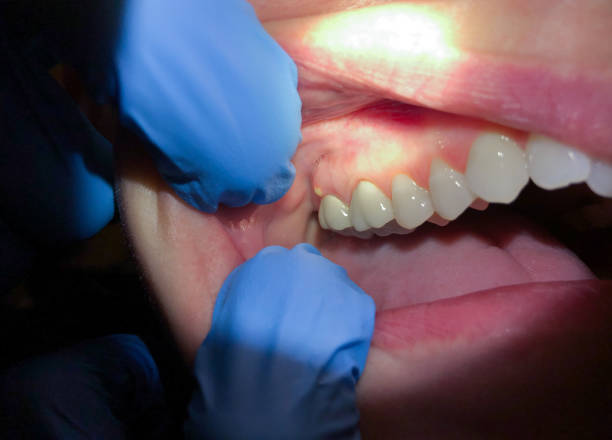 Best Emergency Gum Treatment in Paynesville, MN